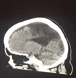 A brain scan showing large areas affected by necrosis after a stroke.